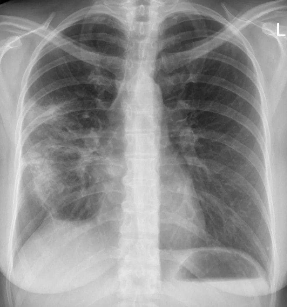 Chest radiograph for self-assessment