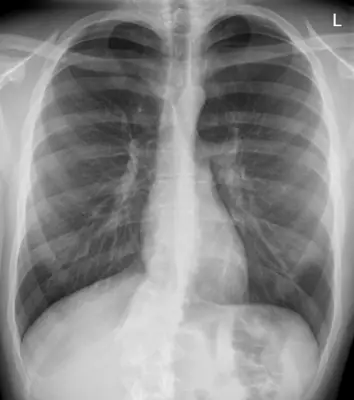 Radiograph from the case bank: Pneumothorax