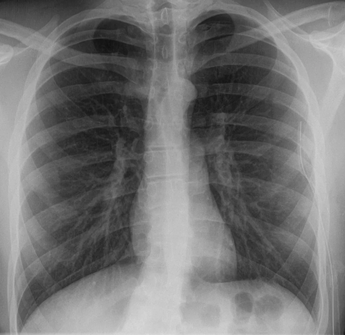 Chest radiograph for self-assessment
