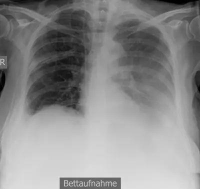 Radiograph from the case bank: Pleural effusion