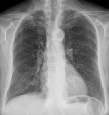 Radiograph from the case bank: Pulmonary oedema (heart failure)