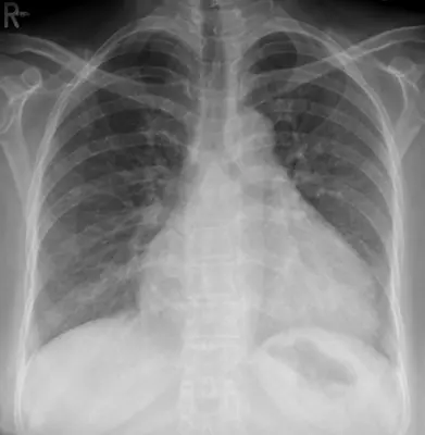 Radiograph from the case bank: Pericardial effusion