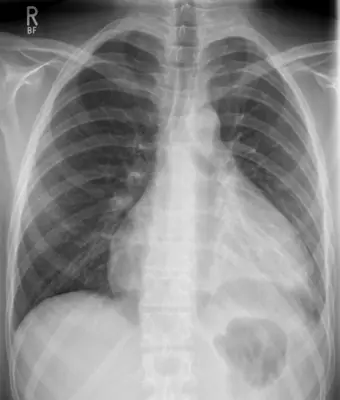 Radiograph from the case bank: Pericardial effusion