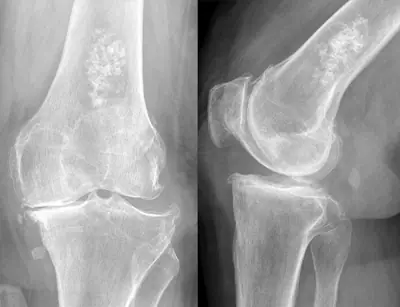 Radiograph from the case bank: Enchondroma