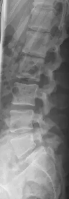 Radiograph from the case bank: Spondylolysis (pars defect)