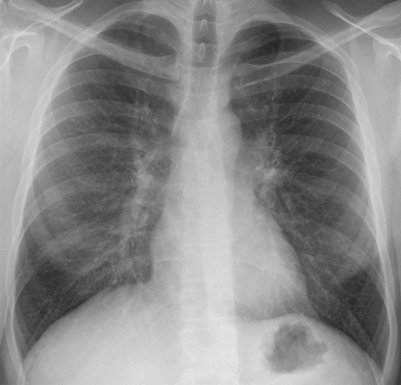 Chest radiograph for self-assessment