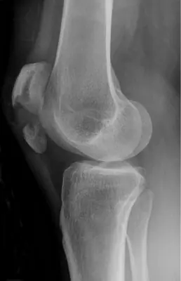 Radiograph from the case bank: Patellar fracture