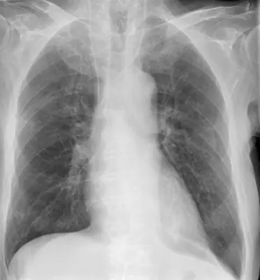 Radiograph from the case bank: Central venous catheter