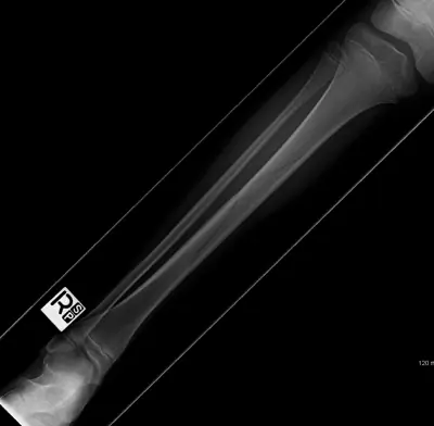 Radiograph from the case bank: Tibial (and fibular) shaft fracture