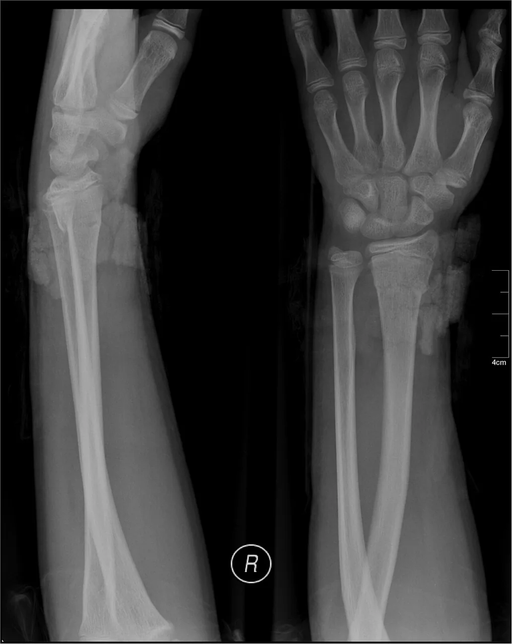 Upper limb radiograph for self-assessment