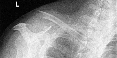 Radiograph from the case bank: Clavicle fracture