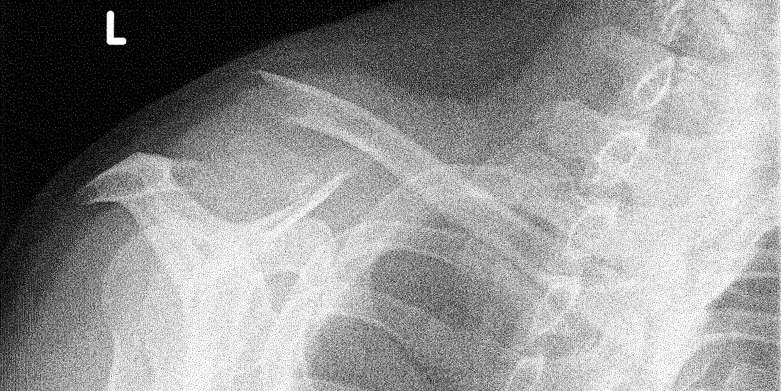 Upper limb radiograph for self-assessment