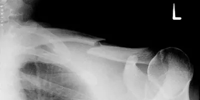 Radiograph from the case bank: Clavicle fracture