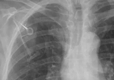 Radiograph from the case bank: Implanted venous access port (port-a-cath)