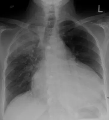 Radiograph from the case bank: Pericardial effusion