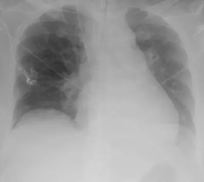 Radiograph from the case bank: Endotracheal tube