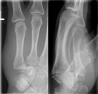 Radiograph from the case bank: Carpal or carpometacarpal dislocation