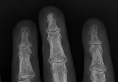 Radiograph from the case bank: Osteoma