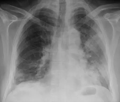 Radiograph from the case bank: Pneumonia (consolidation)