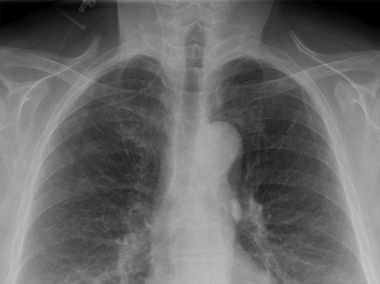 Lines & tubes radiograph for self-assessment