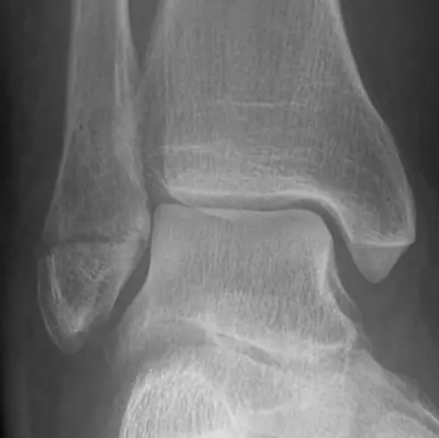 Radiograph from the case bank: Ankle fracture (lateral malleolus)