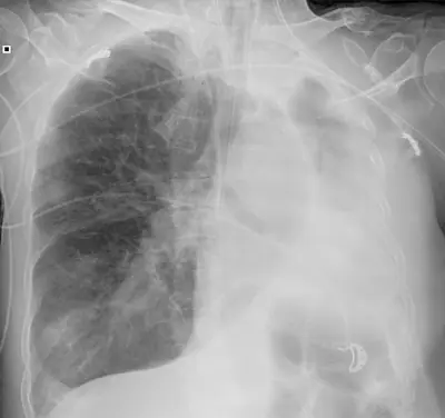 Radiograph from the case bank: Lung collapse (atelectasis)