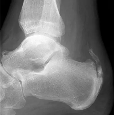 Radiograph from the case bank: Calcaneal spur