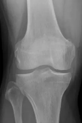 Radiograph from the case bank: Normal knee radiograph