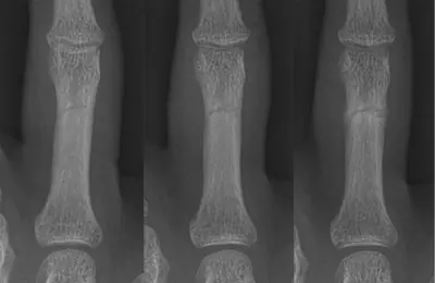 Radiograph from the case bank: Finger (phalangeal) fracture