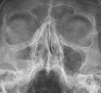 Radiograph from the case bank: Maxillary sinusitis