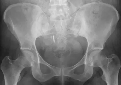 Radiograph from the case bank: Intrauterine contraceptive device (IUCD)
