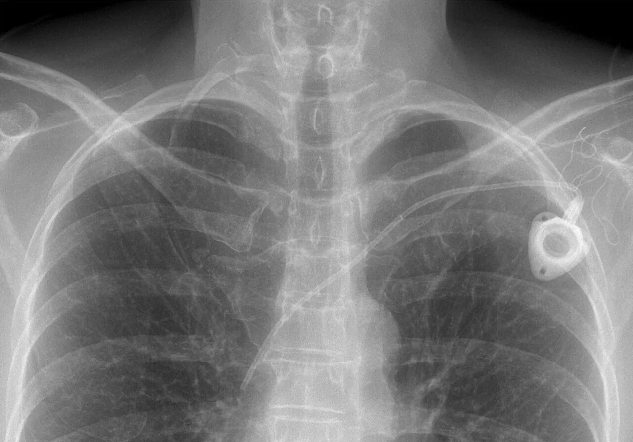 Chest radiograph for self-assessment