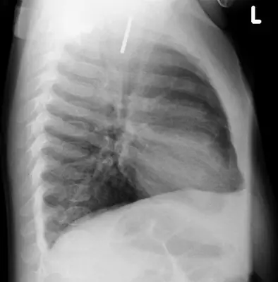 Radiograph from the case bank: Foreign body in the oesophagus