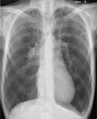 Radiograph from the case bank: Emphysema / COPD (hyperinflation)