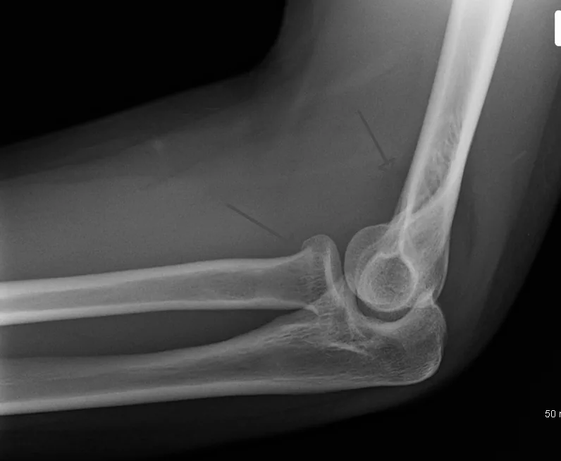 Upper limb radiograph for self-assessment