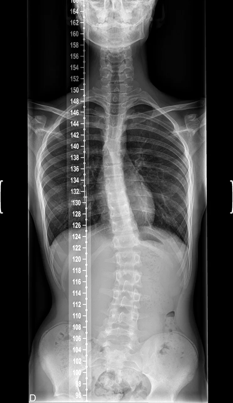 Spine radiograph for self-assessment