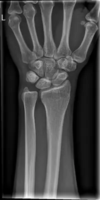 Radiograph from the case bank: Normal wrist radiograph