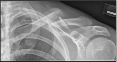 Radiograph from the case bank: Clavicle fracture