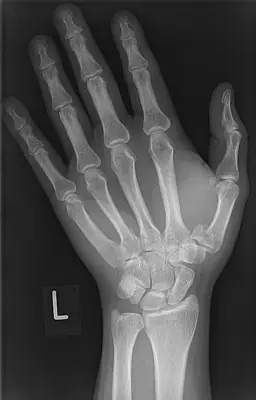 Radiograph from the case bank: Rolando fracture