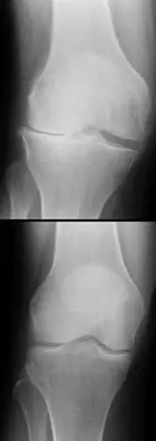 Radiograph from the case bank: Knee osteoarthritis