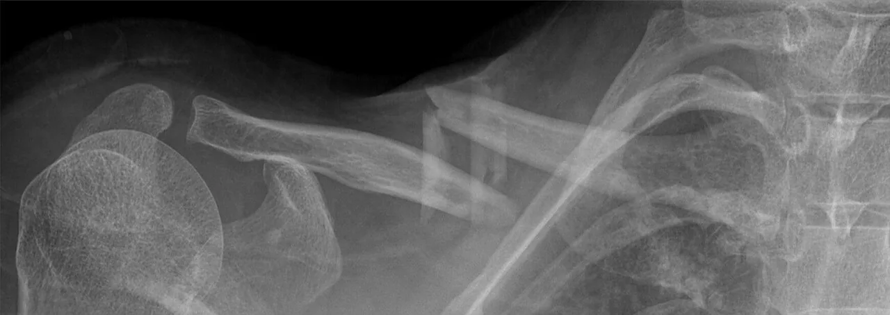 Upper limb radiograph for self-assessment