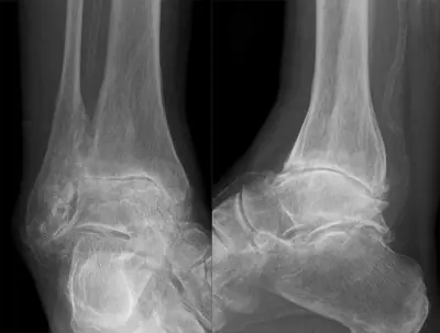 Radiograph from the case bank: Osteoarthritis