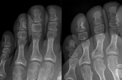 Radiograph from the case bank: Osteoma
