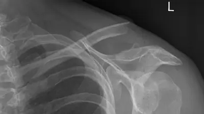 Radiograph from the case bank: Clavicle fracture