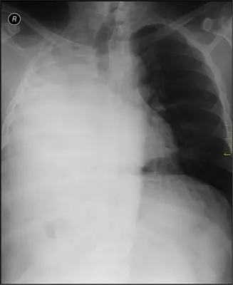 Radiograph from the case bank: Lung collapse (atelectasis)