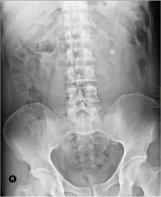 Radiograph from the case bank: Urinary tract calculi (kidney or ureteric stones)