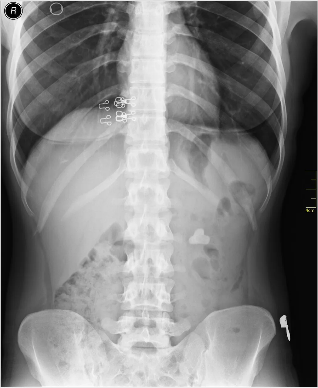 Abdomen radiograph for self-assessment