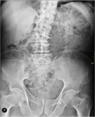Radiograph from the case bank: Scoliosis