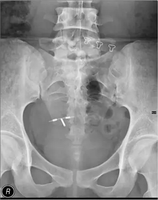 Radiograph from the case bank: Intrauterine contraceptive device (IUCD)