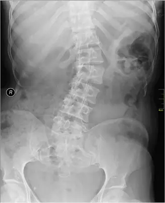 Radiograph from the case bank: Scoliosis